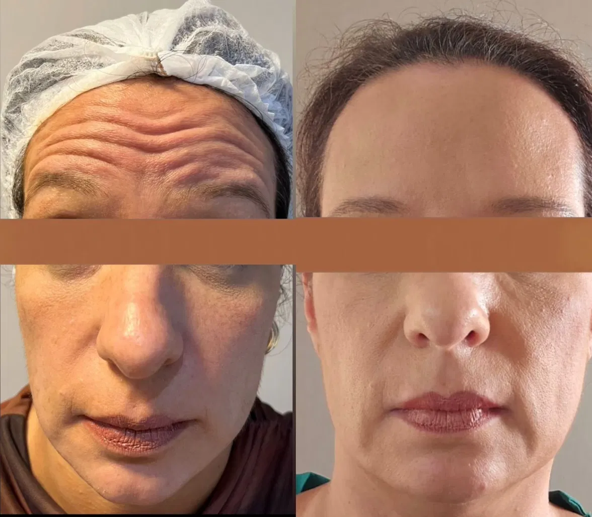 Antes e depois frontal feminino com melhora de linhas da testa.