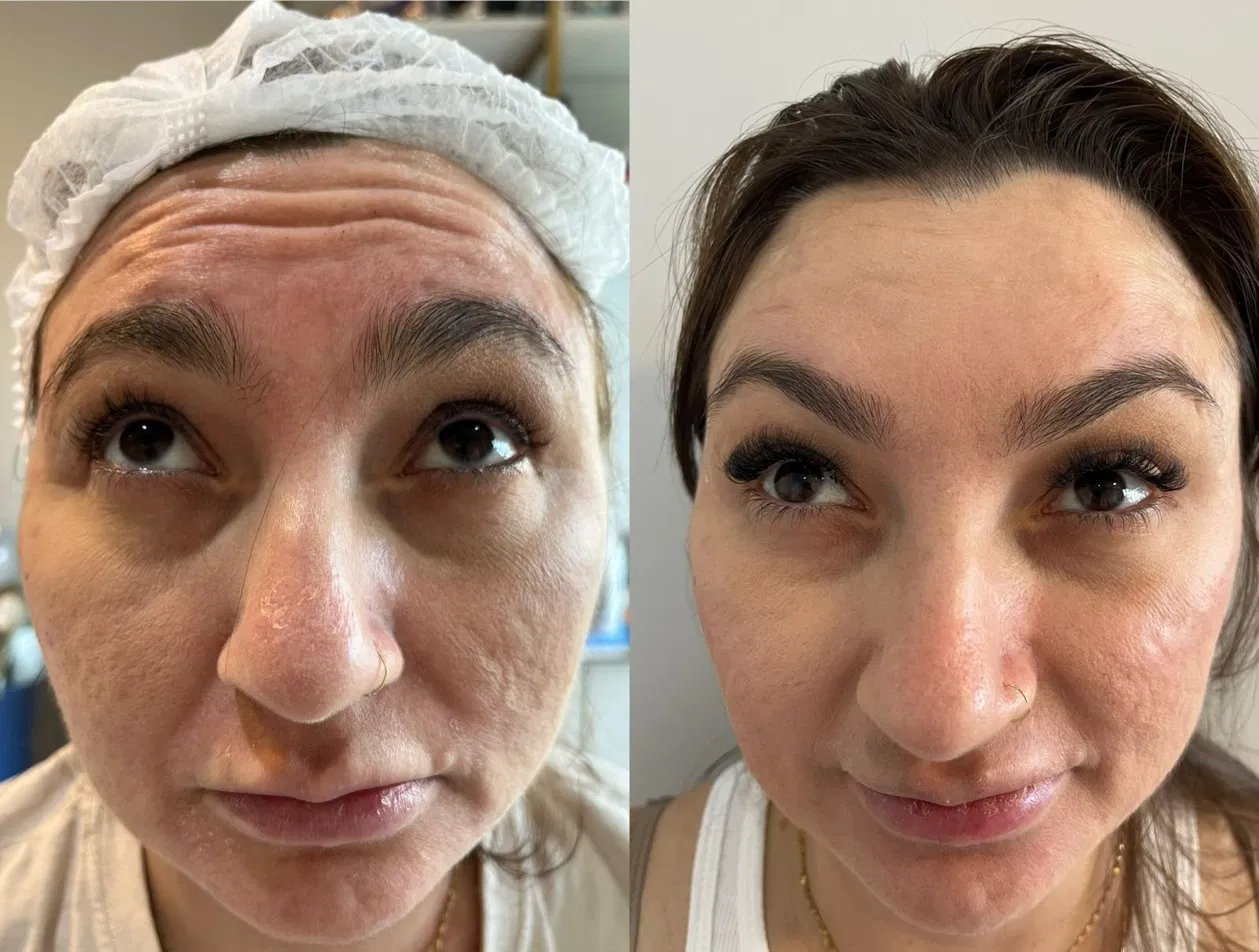 Antes e depois frontal feminino com testa mais lisa e expressão natural.