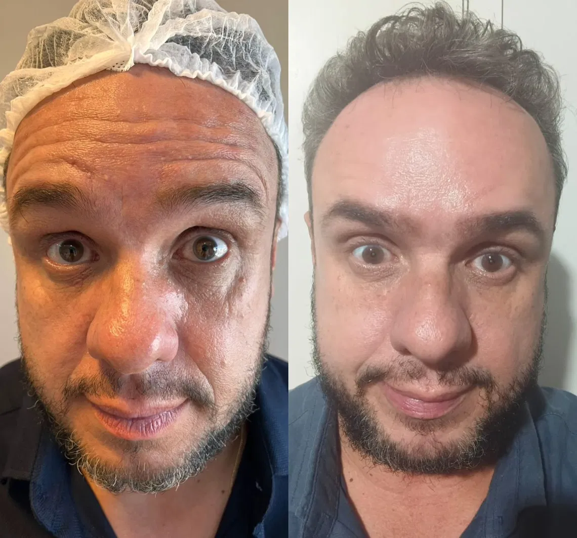 Antes e depois frontal com redução de rugas na testa e expressão mais descansada.