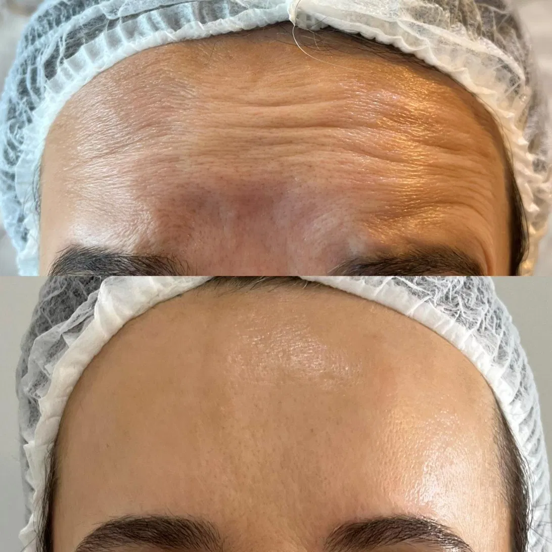 Antes e depois de tratamento na testa com suavização de linhas de expressão.